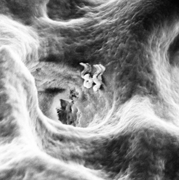 הננובוטים בכניסה לתעלה בדנטין | Theranautilus