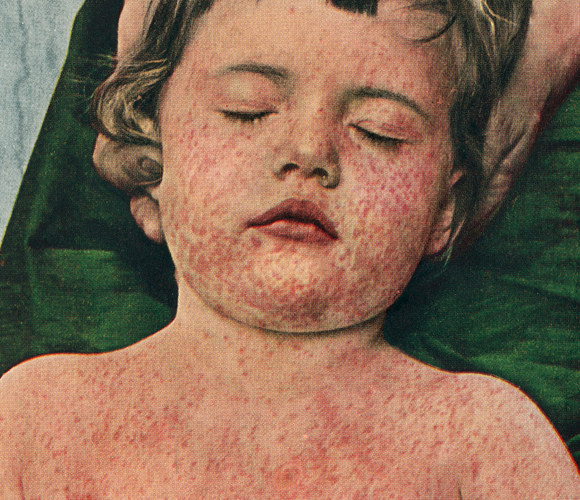 נגיף החצבת הגיע אלינו מבקר, אך יכול להדביק רק בני אדם. ילד חולה חצבת | מקור: Larry Dunstan / Science Photo Library