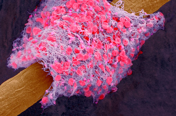 הסכנה הגדולה של הגלולה. קריש דם בלב. צילום צבוע של מיקרוסקופ אלקטרונים סורק (SEM) | מקור:  LENNART NILSSON / BOEHRINGER INGELHEIM / TT / SCIENCE PHOTO LIBRARY