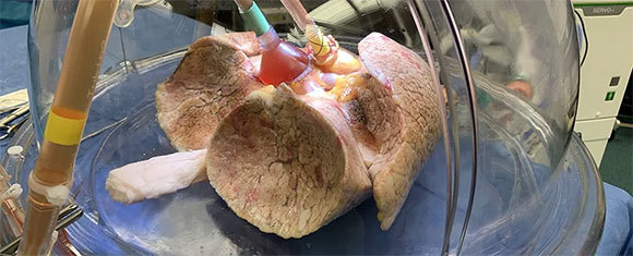 ריאה מטופלת באנזימים | קרדיט: University Health Network