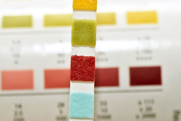 وريقة لقياس السّكّر في البول | تصوير: Science Photo library