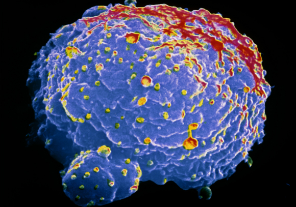 صورة بالألوان لخليّة سرطانيّة هجينة Hybridoma قادرة على أداء عملها لفترة طويلة | المصدر: Science Photo Library