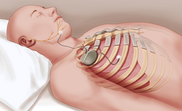 ناظمة قلبية لكشف ومنع انقطاع النفس الانسدادي | رسم توضيحي: BSIP / JACOPIN / SCIENCE PHOTO LIBRARY