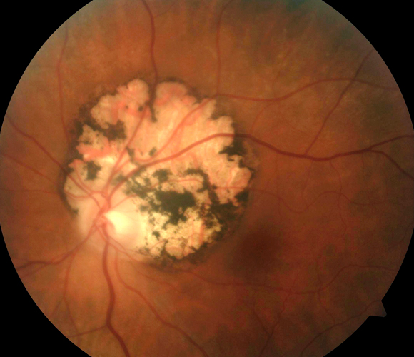 המחלה עלולה להיות מסוכנת מאוד לעוברים. פגיעה של טפיל טוקסופלזמה ברשתית העין | צילום: Science Photo Library