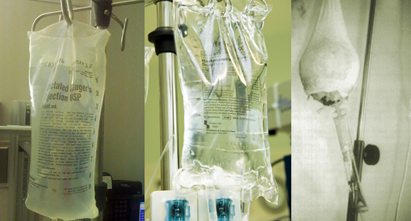 נוזלים לווריד. עירוי מאגוז קוקוס (מימין) תמיסת הרטמן ותמיסת רינגר | צילומים: ויקיפדיה, American Journal of Emergency Medicine