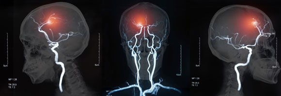 כ-60 אחוז מהאנשים שיחוו אירוע מוחי ימותו או יסבלו מנכות ארוכת טווח. מיפוי כלי דם במוח | מקור: Shutterstock