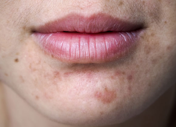 נערה עם פצעי אקנה | penton, Shutterstock