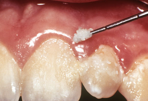 שיניים של מטופל עם רובד חיידקים | CNRI, SPL