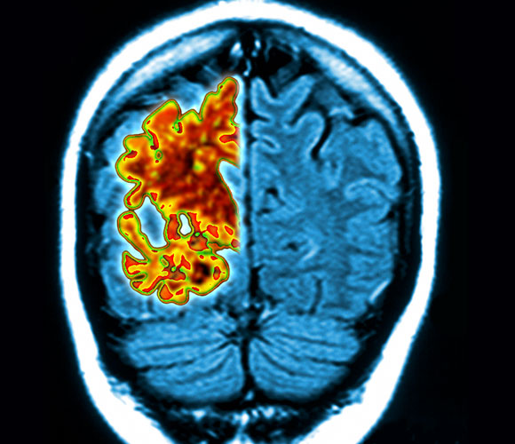 ניוון בצד שמאל של המוח, סריקה