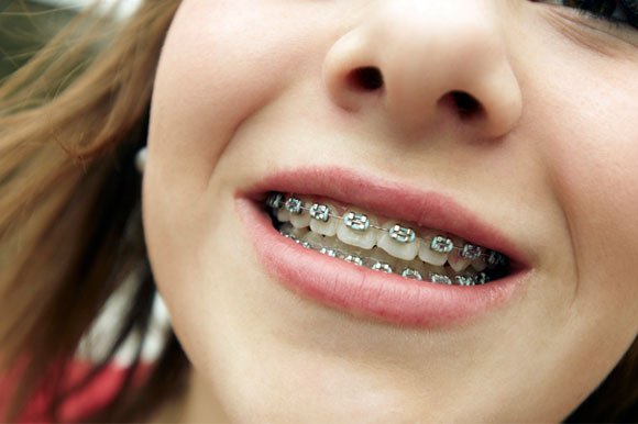 אישה עוברת יישור שיניים