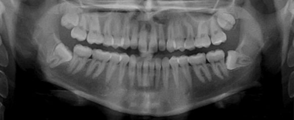 רנטגן של שיניים צפופות