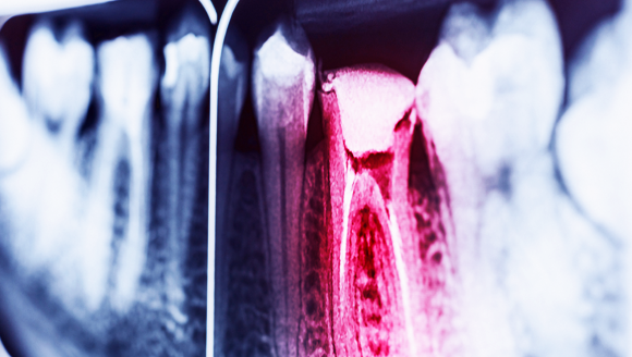 כשקצב הפירוק של אמייל השן עולה על קצת ההתחדשות, נוצרת עששת. צילום רנטגן של חור בשן | צילום: Shutterstock