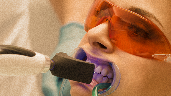 ריכוז גבוה של מימן על-חמצני חודר שאת שכבת האמייל ומלבין את הדנטין. טיפול הלבנה במרפאת שיניים | צילום: Shutterstock