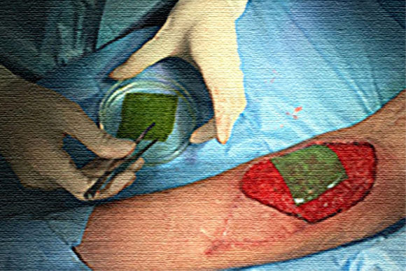 החבישה מכילה קולגן ואצות חד-תאיות ומונחת על הפצע למשך 21 יום | מתוך המאמר Miguel Obaíd et al