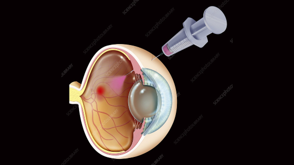 שיפור לא מוסבר בראייה. טיפול ב-AMD באמצעות הזרקת VEGF לעין | איור: JACOPIN / SCIENCE PHOTO LIBRARY