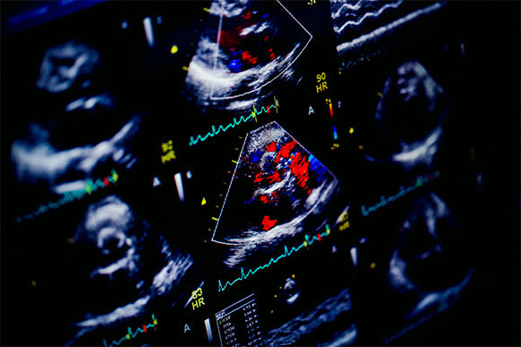 **תמונה של אקו לב** על סמך בדיקות אקו-לב זיהו מבין כלל הנבדקים 818 ילדים שסבלו ממחלת לב שגרונית סמויה. | צילום: Chaikom Shutterstock