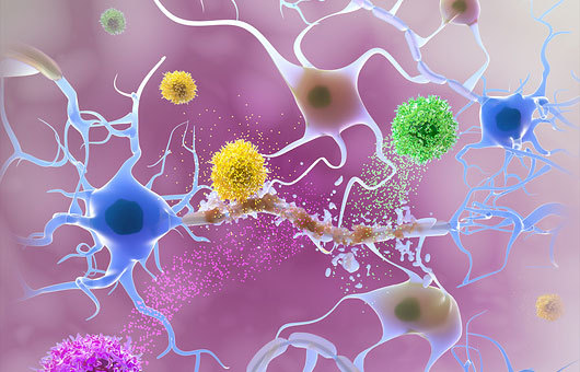 טרשת נפוצה. תאי מערכת החיסון (אדום, צהוב, ירוק), פוגעים במעטפת המיאלין (חום) של שלוחות תאי העצב | איור: HOARAU HUGUES DOMINIQUE / BSIP / SCIENCE PHOTO LIBRARY