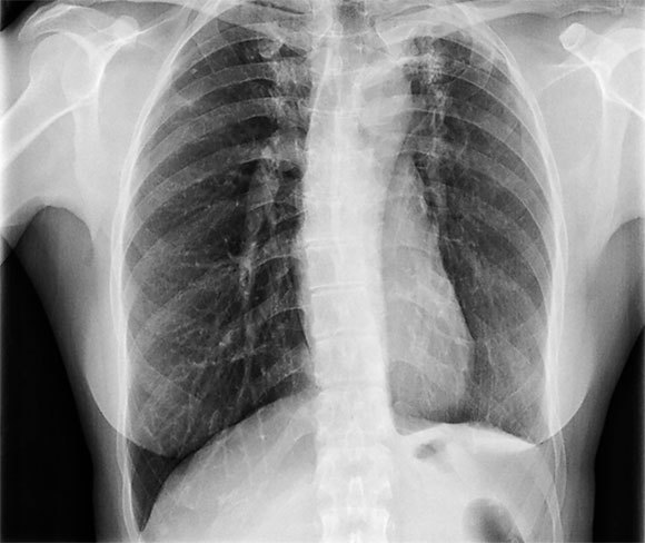 צילום חזה שמראה נזק לריאות כתוצאה משחפת | Dr. P. Marazzi, Science Photo Library