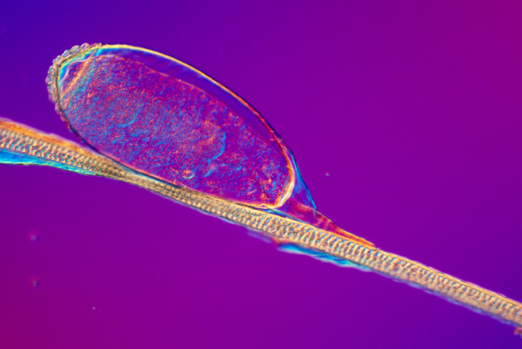 ביצת כינה על שערה של אדם | SPL