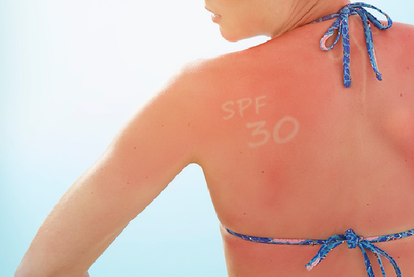 Frau mit Sonnenbrand | Foto: SCIENCE PHOTO LIBRARY