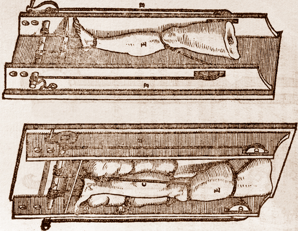 מתקן לקיבוע רגל שבורה, המאה ה-16 | Science Photo Library