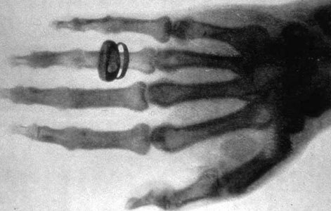 Die Hand des Schweizer Forschers Albert von Koelliker in einer Aufnahme, die Wilhelm Röntgen 1896 gemacht hat | Quelle: Wikipedia, gemeinfrei