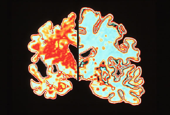 סריקת מוח רגיל (מימין) ושל חולה אלצהיימר (משמאל) | קרדיט: Alfred Pasieka / Science Photo Library 