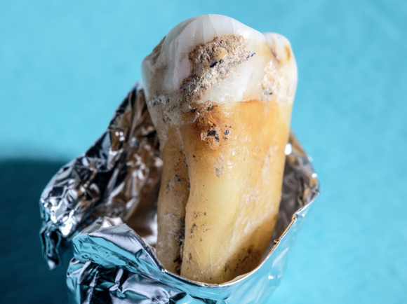 פלאק עתיק על שן אדם קדום. צילום: Werner Siemens Foundation, Felix Wey