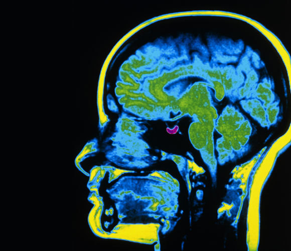 צילום MRI עם בלוטת יותרת המוח מודגשת בסגול | Scott Camazine, Science Source, Science Photo Library