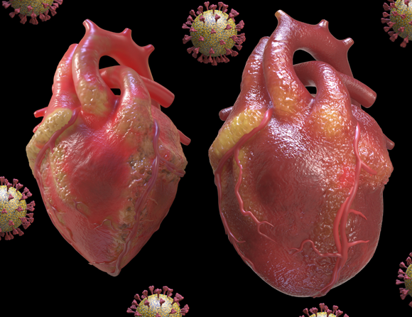 הדמיה של לב דלקתי (מימין) לעומת לב בריא | מקור: TIM VERNON / SCIENCE PHOTO LIBRARY
