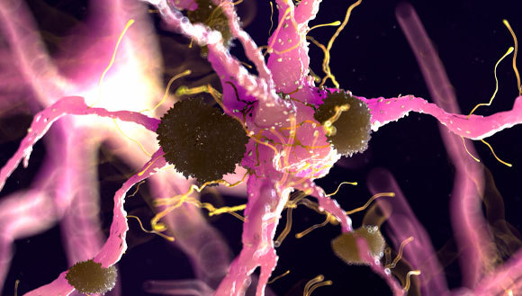 אין שום קשר לחיסוני הקורונה. משקעי החלבון (בחוּם) הנוצרים במחלת אלצהיימר על תאי עצב | איור: SEBASTIAN KAULITZKI / SCIENCE PHOTO LIBRARY