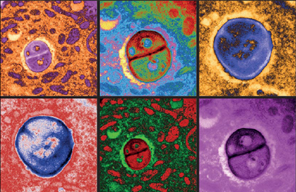 צילומים צבועים במיקרוסקופ אלקטרונים של תאי סרטן העור המכילים בתוכם חיידקים | צילום: מכון ויצמן למדע