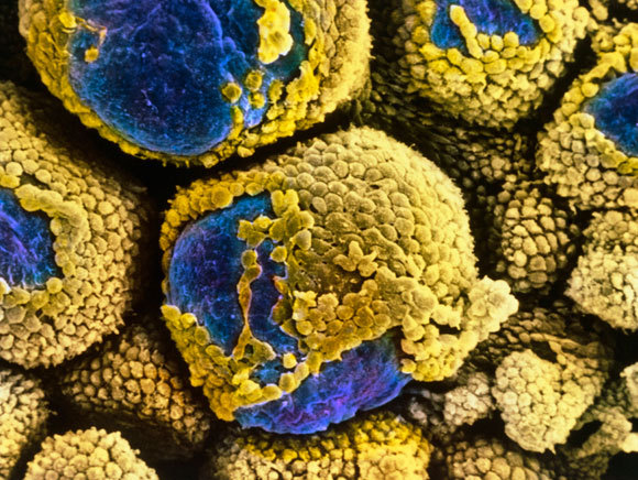 تكيّس في المبيضَين، تصوير (ملوّن) بالمجهر الإلكترونيّ | المصدر: PROFESSORS P.M. MOTTA & S. MAKABE / SCIENCE PHOTO LIBRARY