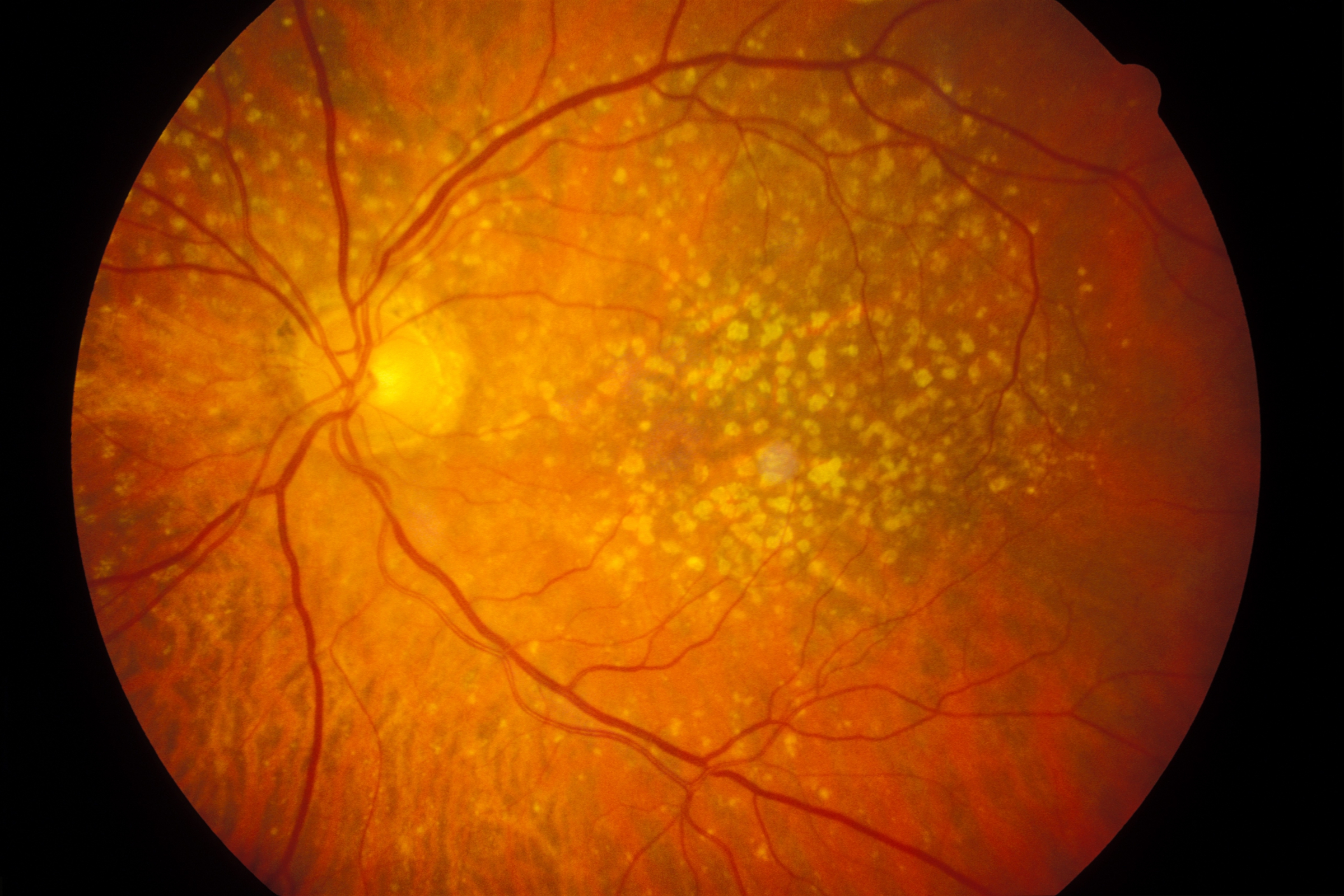 הכתמים הצהובים בצילום העין מעידים על המחלה. עין של חולה בניוון מקולרי גילי | מקור: Science Photo Library