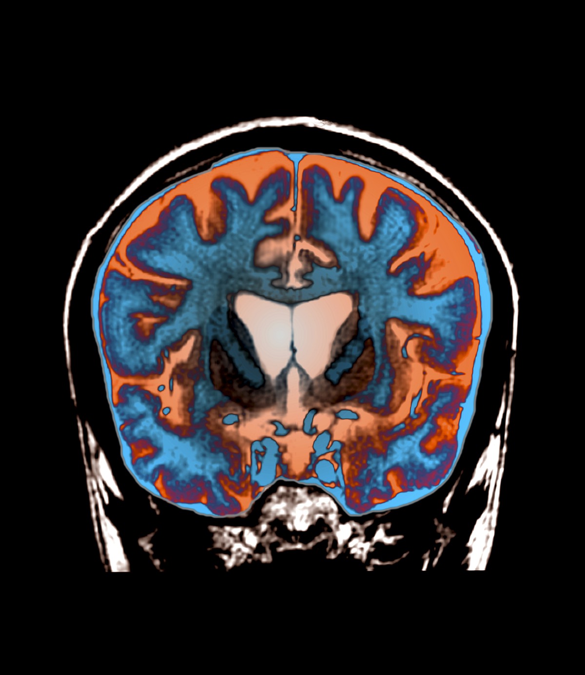 סריקת MRI צבועה של מוח של חולה הנטינגטון, מקור: spl