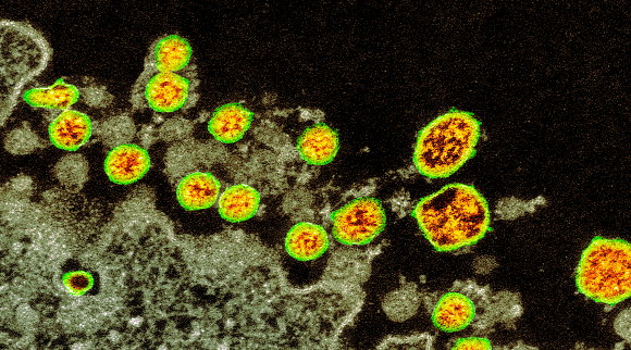 SARS-CoV-2 viruses (yellow) as seen through an electron microscope | Source: CDC / SCIENCE PHOTO LIBRARY