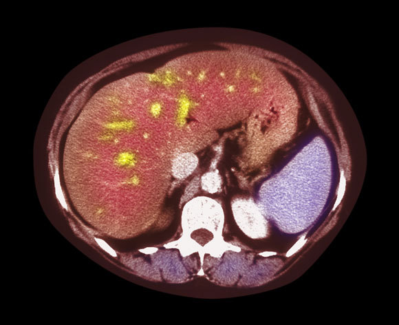 ויש בו הצטברות שומן (כתמים צהובים) | Simon Fraser, Freeman Hospital, Newcastle Upon Tyne, SPL