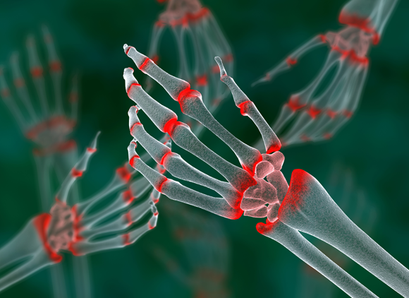 הדמייה של המפרקים הדלקתיים (באדום) בידיים של חולה בדלקת מפרקים שגרונית | מקור: ANIMATED HEALTHCARE LTD / SCIENCE PHOTO LIBRARY