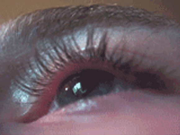 אדוות שרירים בעפעף | צילום: Leitz31337, Wikimedia Commons