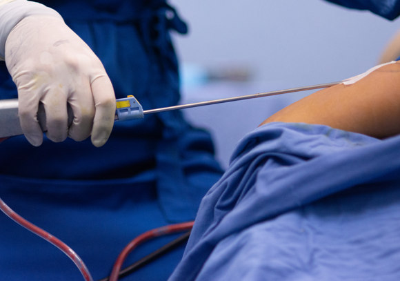 רוב ניתוחי שאיבת השומן מתמקדים בשאיבה של השומן התת עורי בבטן, כפי שנראה כאן | Shutterstock, Harvey Combariza