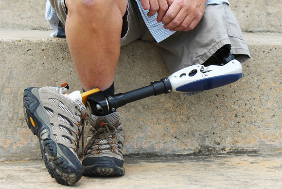 הרגל הבריאה מתעייפת מהר, בעיקר בהליכה על משטח שאינו ישר ואחיד. אדם עם רגל תותבת | צילום: Shutterstock