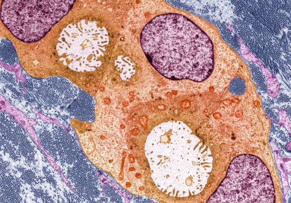 צילום מיקרוסקופי צבוע של גידול סרטני (בכתום) ברקמת השד | מקור: STEVE GSCHMEISSNER / SCIENCE PHOTO LIBRARY