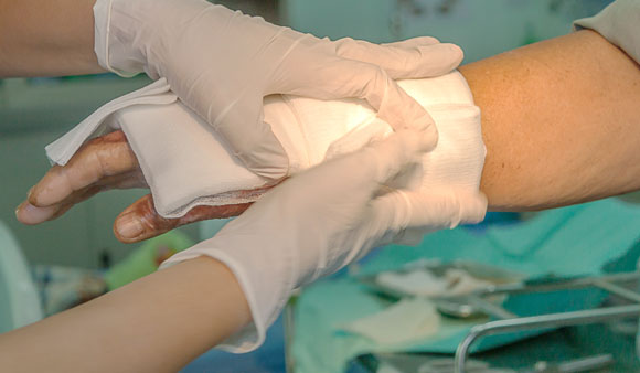 חבישה של כוויה | kirov1976, Shutterstock