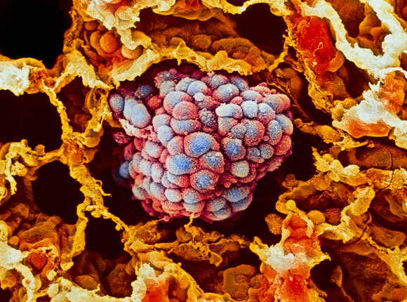  תמונת מיקרוסקופ אלקטרונים סורק של גידול בריאה | Moredun Animal Health Ltd, SPL