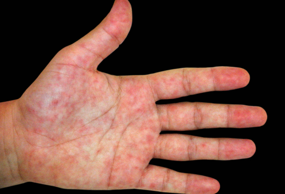 פגיעות דמויות כוויות קור על כף יד של חולה ב-COVID-19 | צילום: ISM / SCIENCE PHOTO LIBRARY