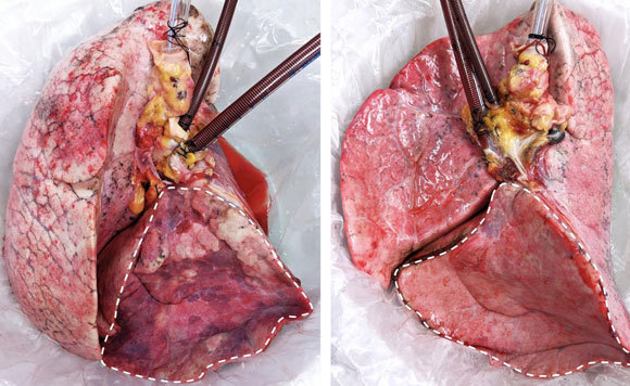 ריאת אדם לאחר EVLP שלא הצליח (שמאל) ולאחר הטיפול עם החזיר (ימין) | צילום: Ahmed Hozain and John O'Neill/Columbia Engineering