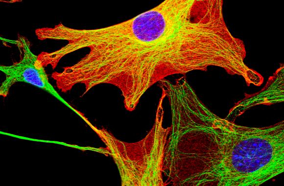 פיברולסטים מסרטן שד בעכברים | צילום במיקרוסקופ קונפוקאלי: DAVID ROBERTSON, ICR / SCIENCE PHOTO LIBRARY