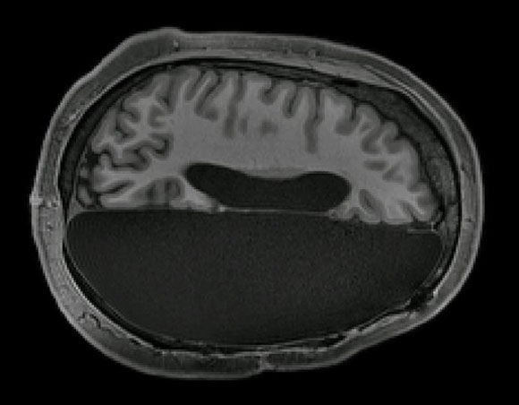 כריתת מחצית המוח | Caltech Brain Imaging Center