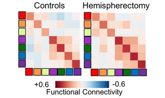 דירוג החיבור הרשתי של בעלי מוח שלם (משמאל) וחצי מוח (מימין) | מקור: Caltech Brain Imaging Center