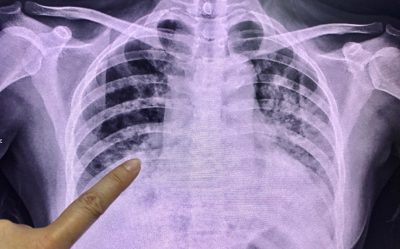 תגובה קשה של מערכת החיסון עלולה להתפתח לדלקת ריאות מסוכנת. צילום רנטגן של חולת קורונה | מקור: Good Image Studio, Shutterstock